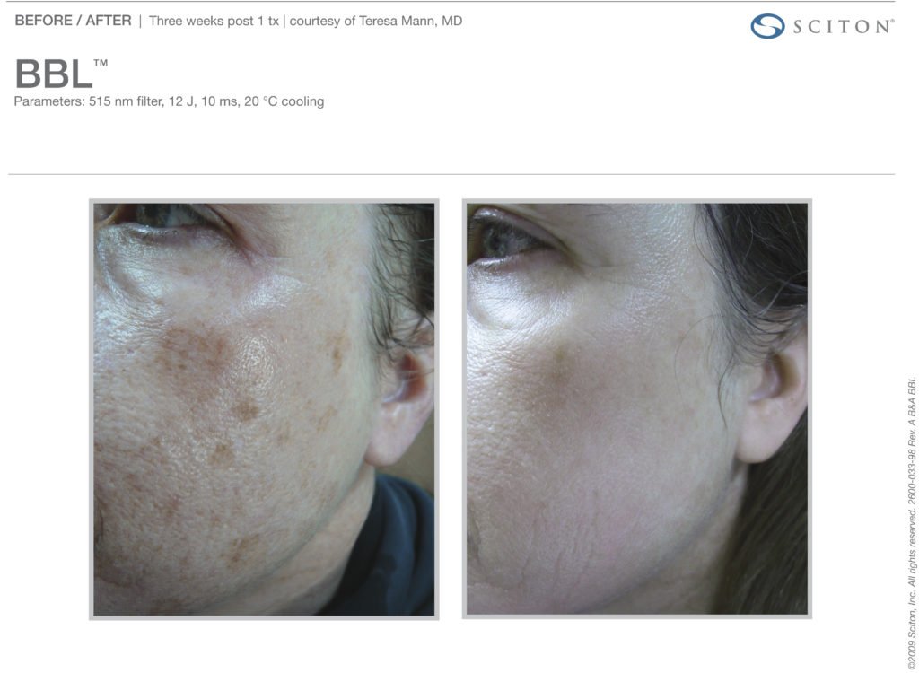 BBL-Light-Therapy-image7