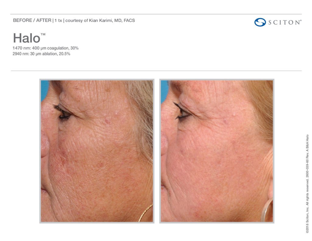 Halo Laser Resurfacing before after 1