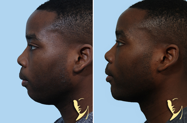 Chin Implant Before After 55