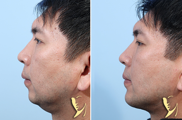 Chin Implant with Submental Lipectomy with Platysmaplasty 150
