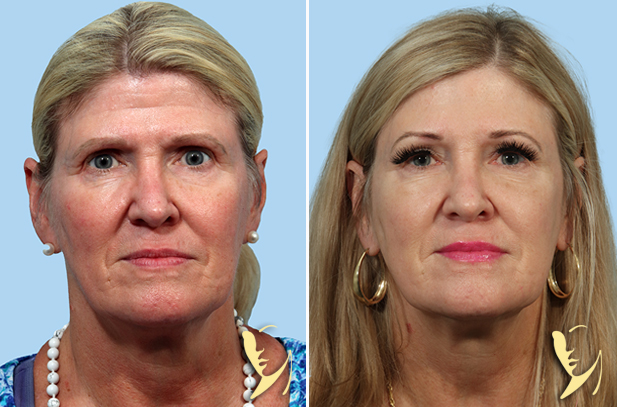 Endoscopic Brow Lift Before After 55