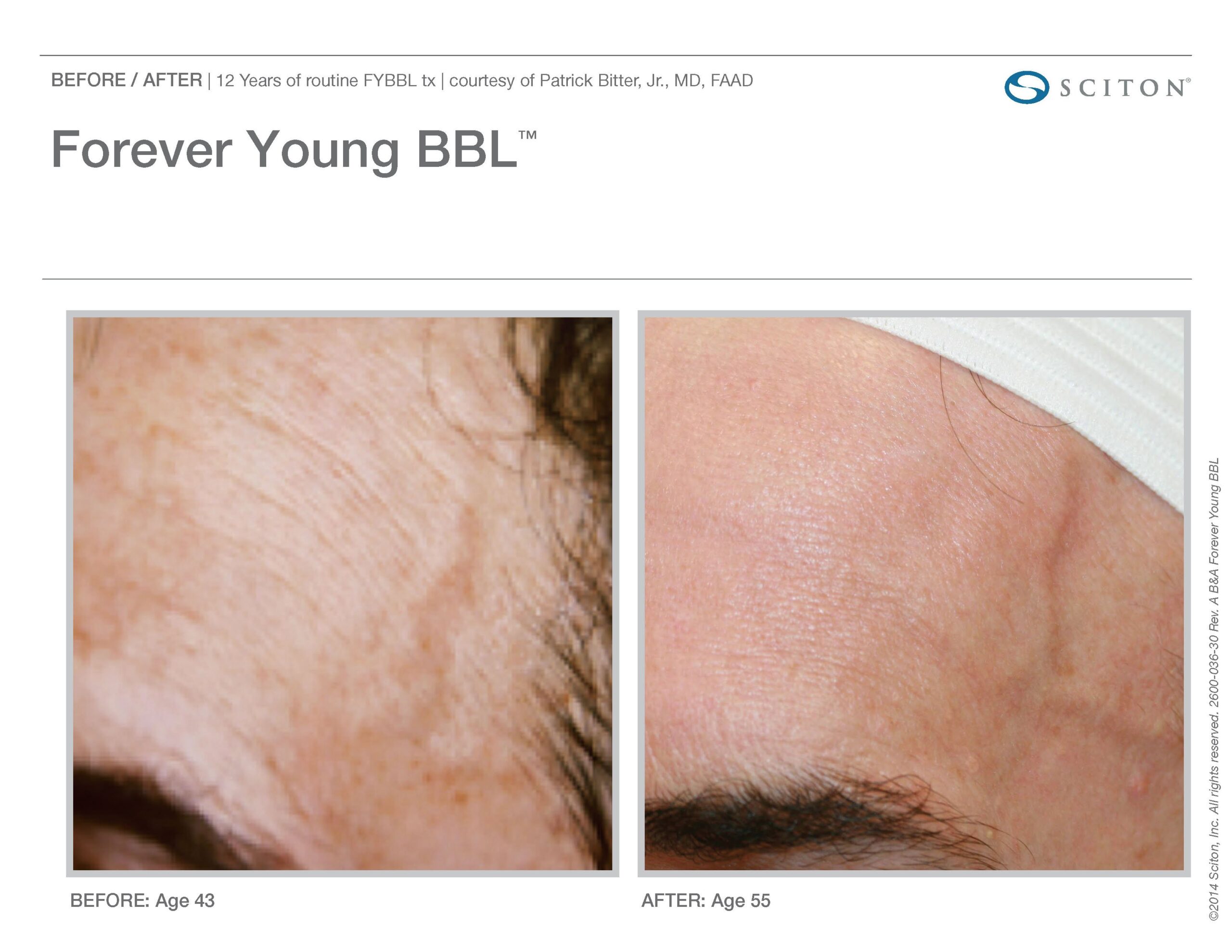 FYBBL-before-after-photo-5
