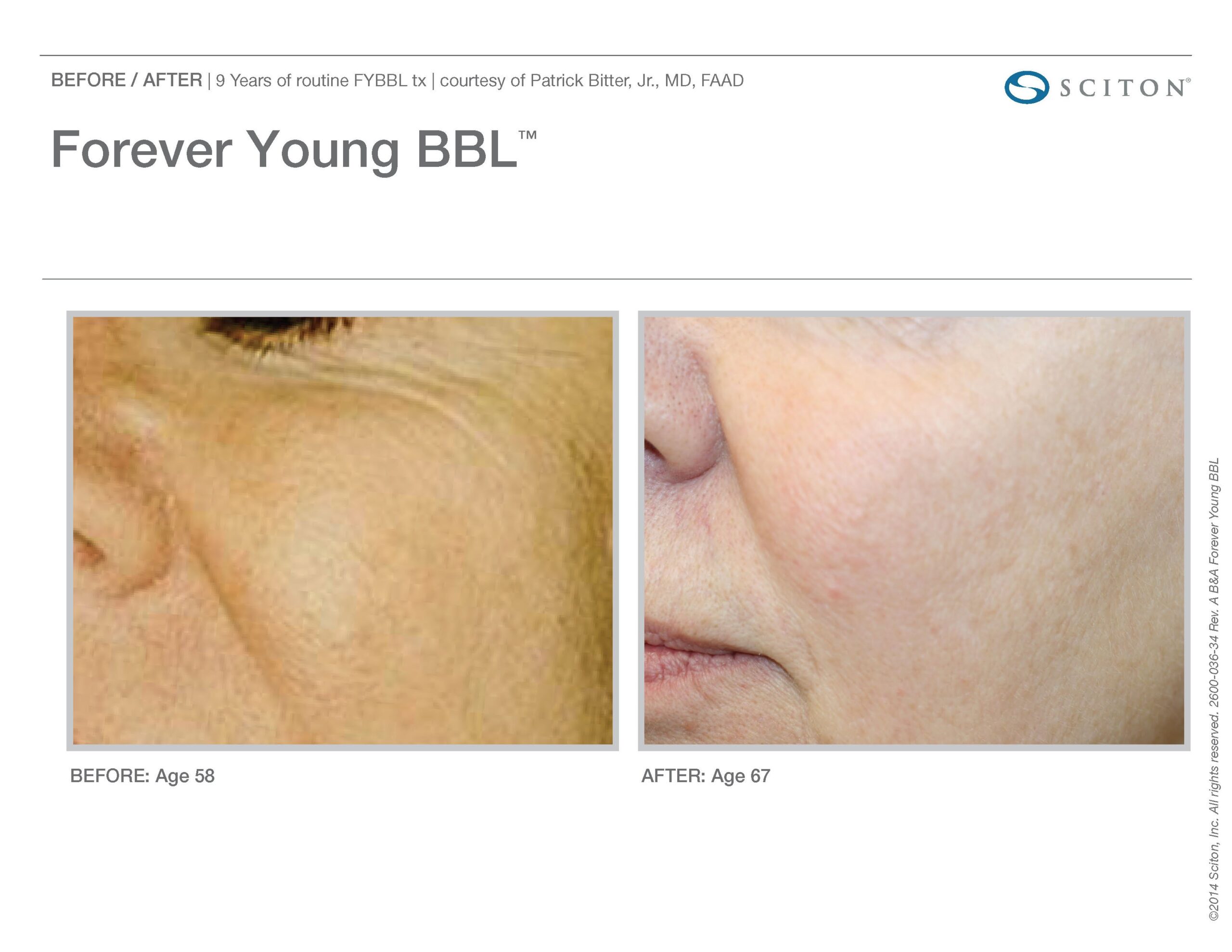 FYBBL-before-after-photo-7
