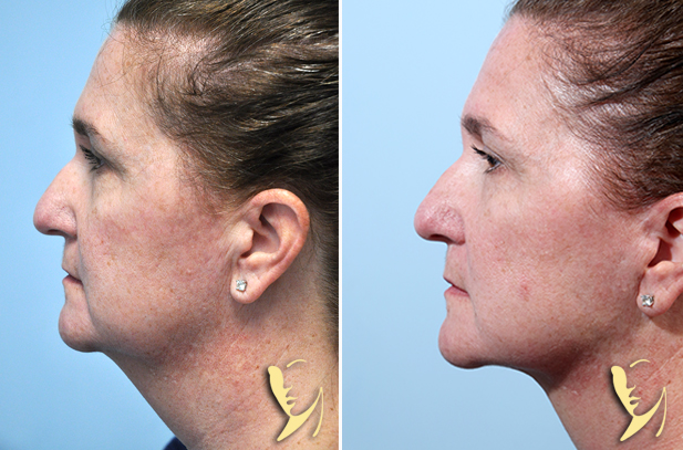 Facelift before after 75