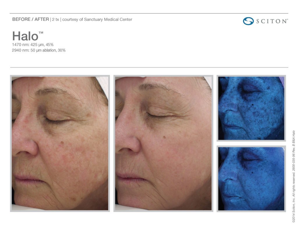 Halo Laser Resurfacing before after 2