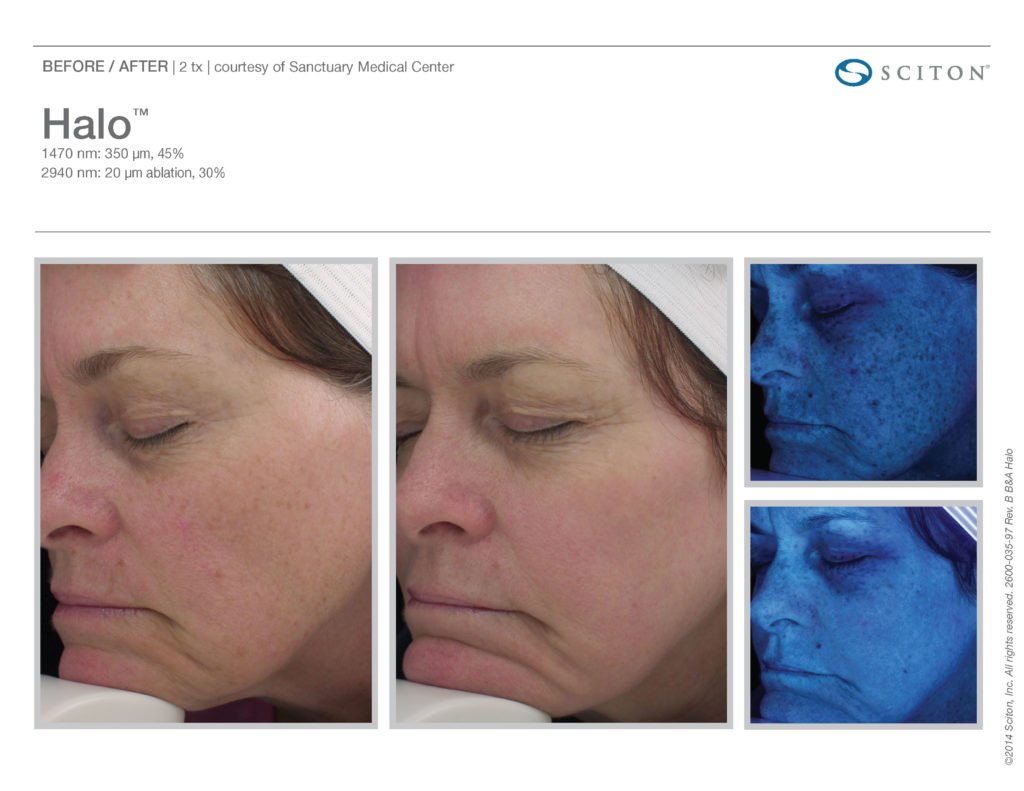 Halo Laser Resurfacing before after 3