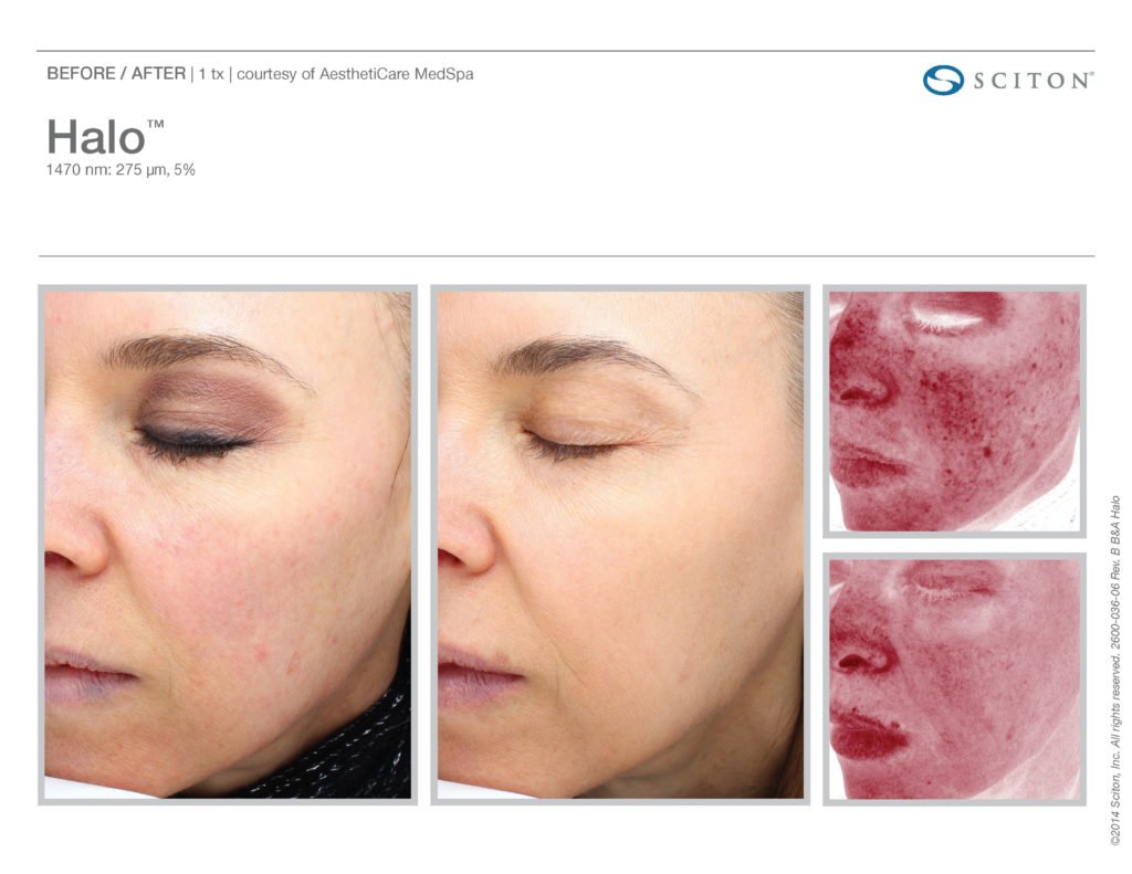 Halo Laser Resurfacing before after 8