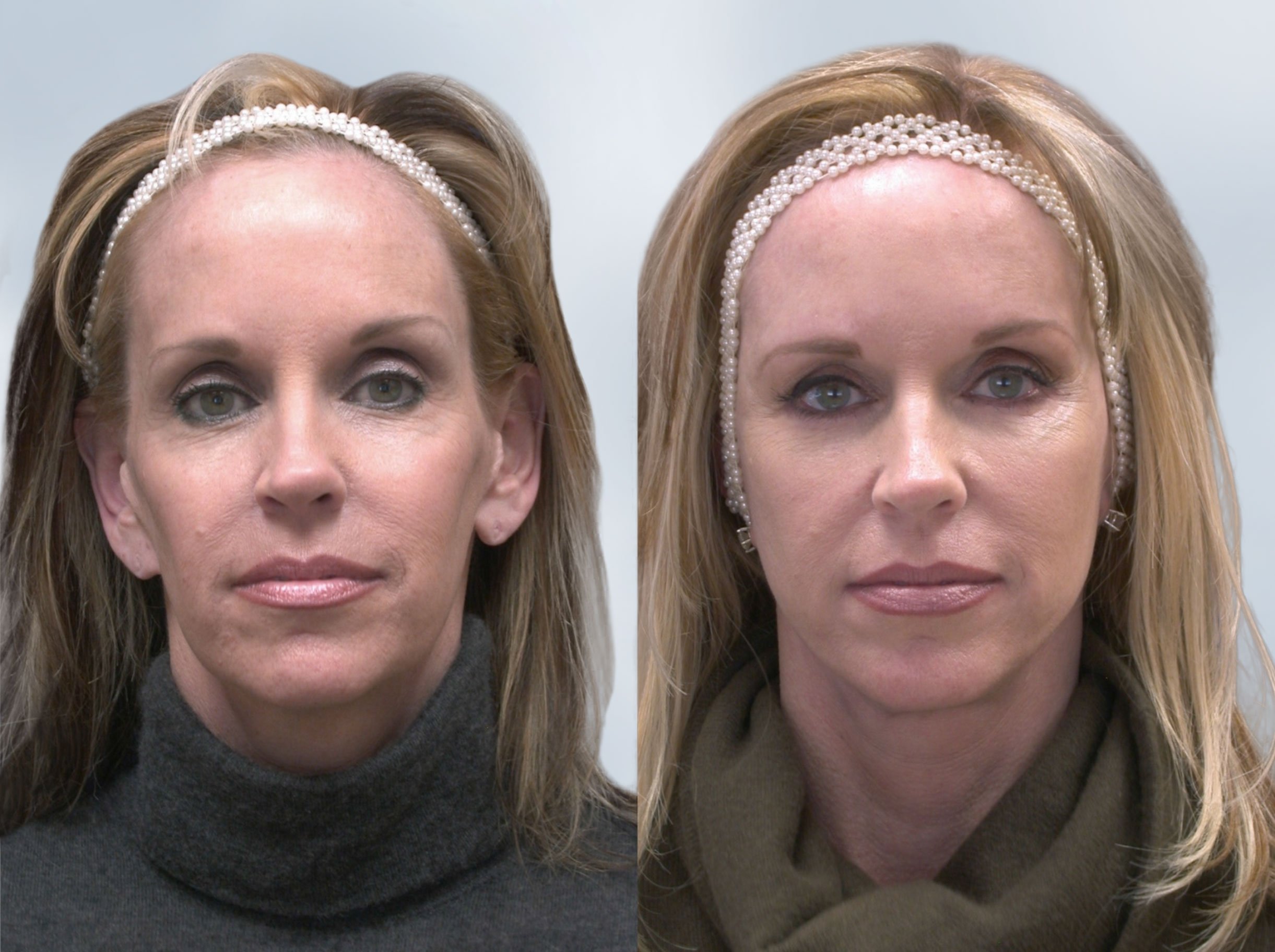 Sculptra Before and After 3