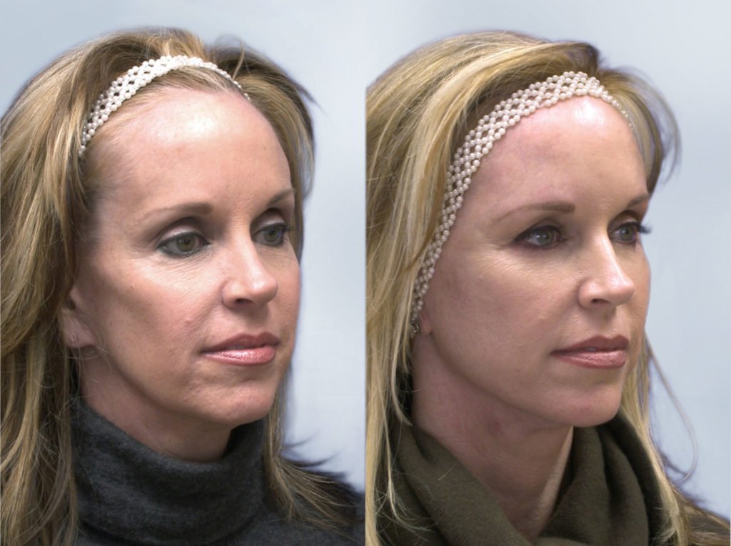 Sculptra Before and After 4