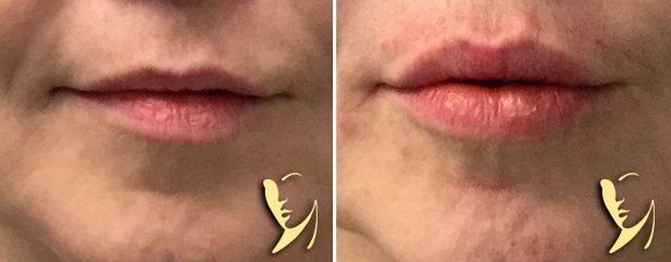 lip enhancement before and afters