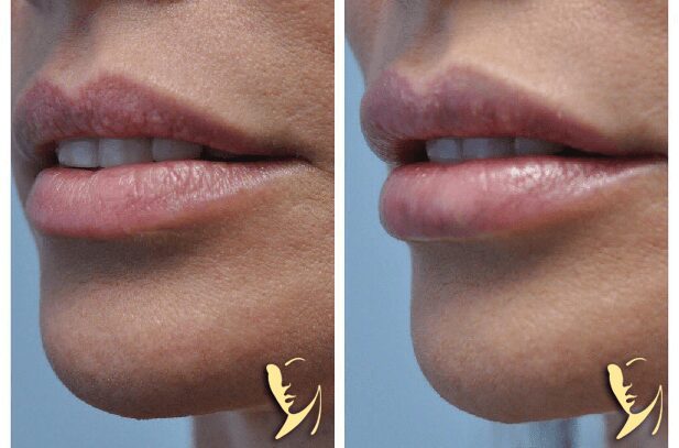 Lip-Enhancement-Kysse