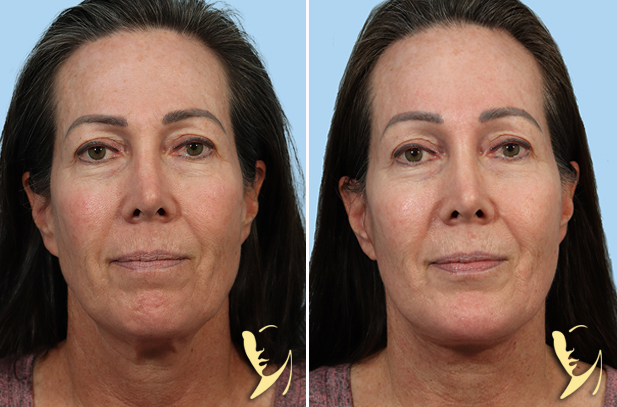 Lower Facelift + Chin Implant + Brow Lift before after front view 130