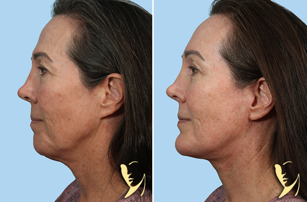 Lower Facelift + Chin Implant + Brow Lift before after side view 130