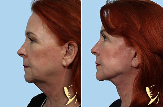 Lower Facelift + Upper Blepharoplasty (Eyelids) 125 side view before and after