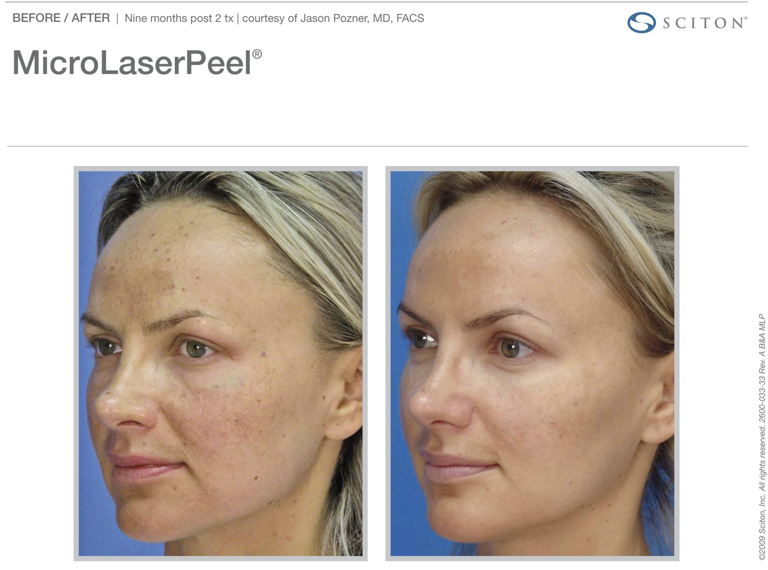 micro-laser-peel-before-after-8