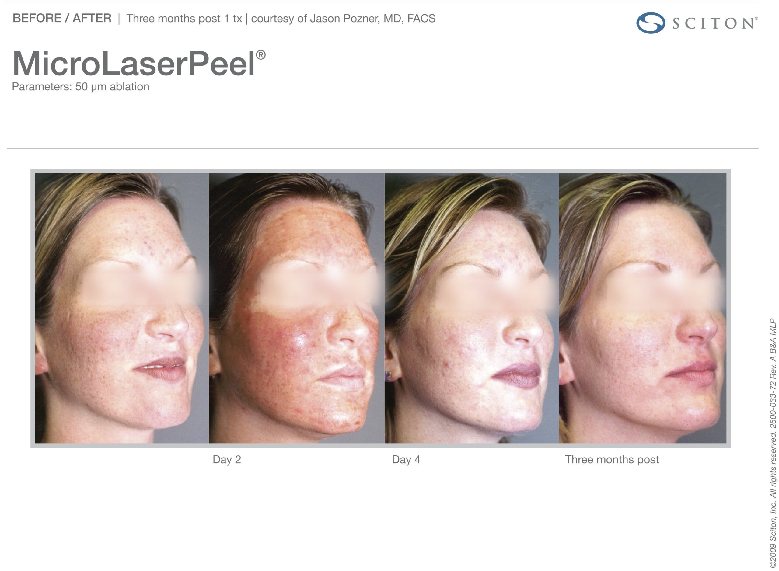 micro-laser-peel-before-after-7