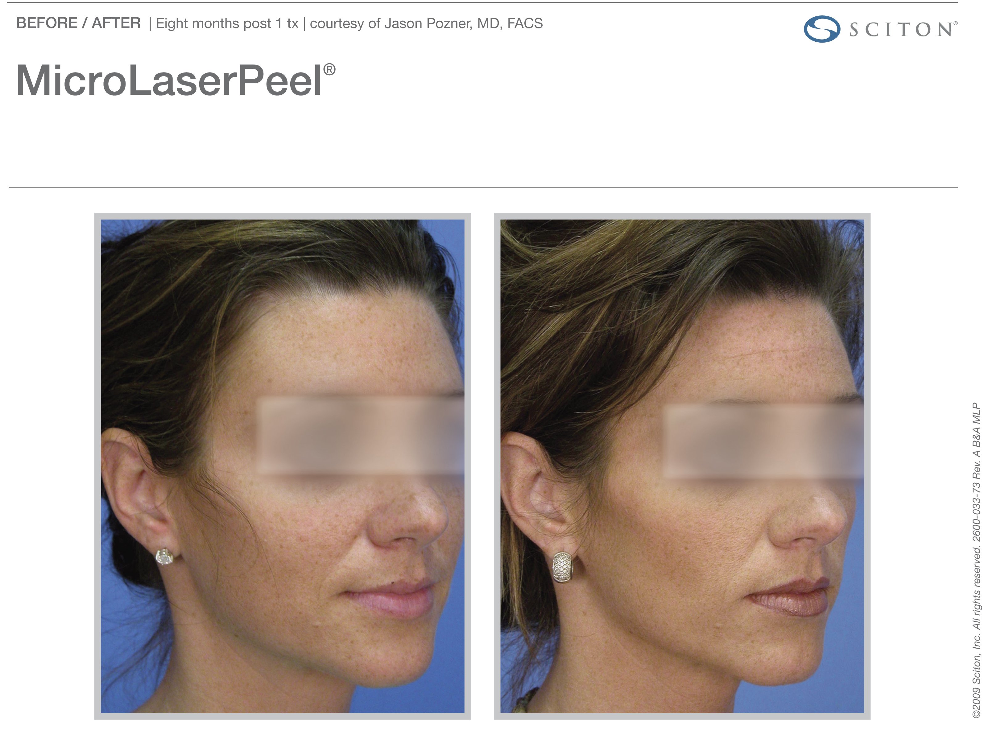 micro-laser-peel-before-after-6