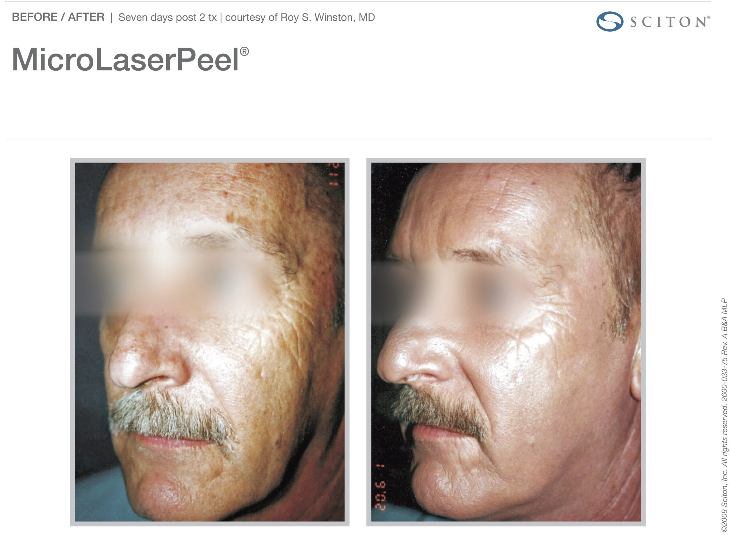 micro-laser-peel-before-after-4