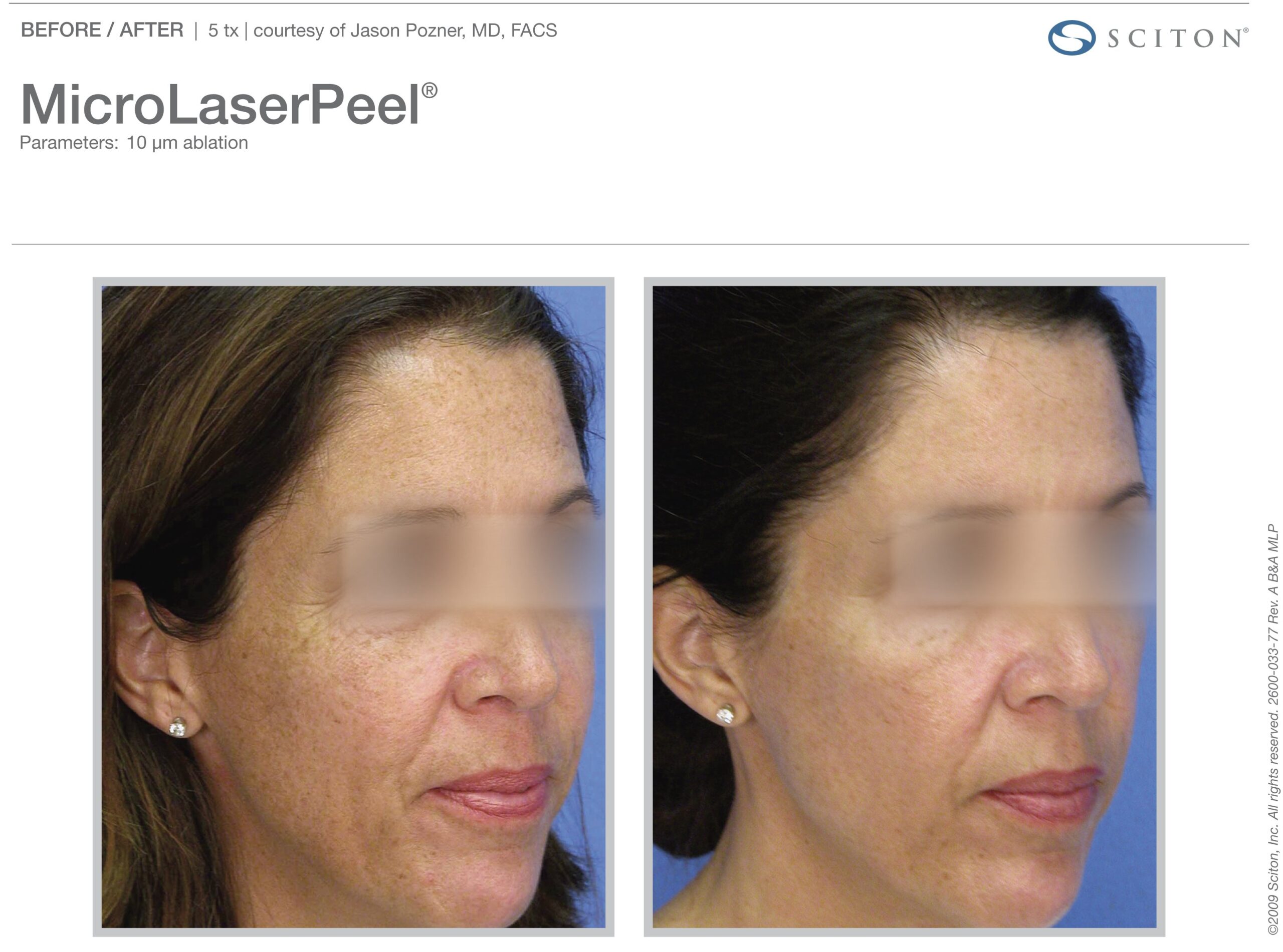 micro-laser-peel-before-after-3