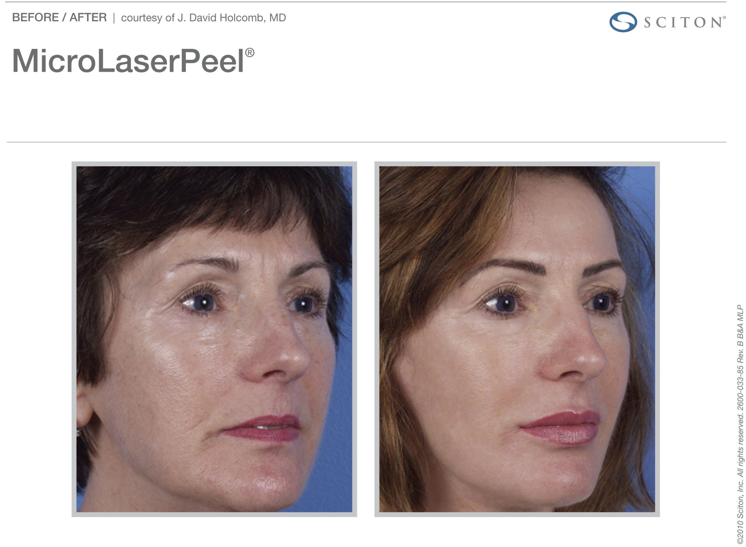 micro-laser-peel-before-after-1