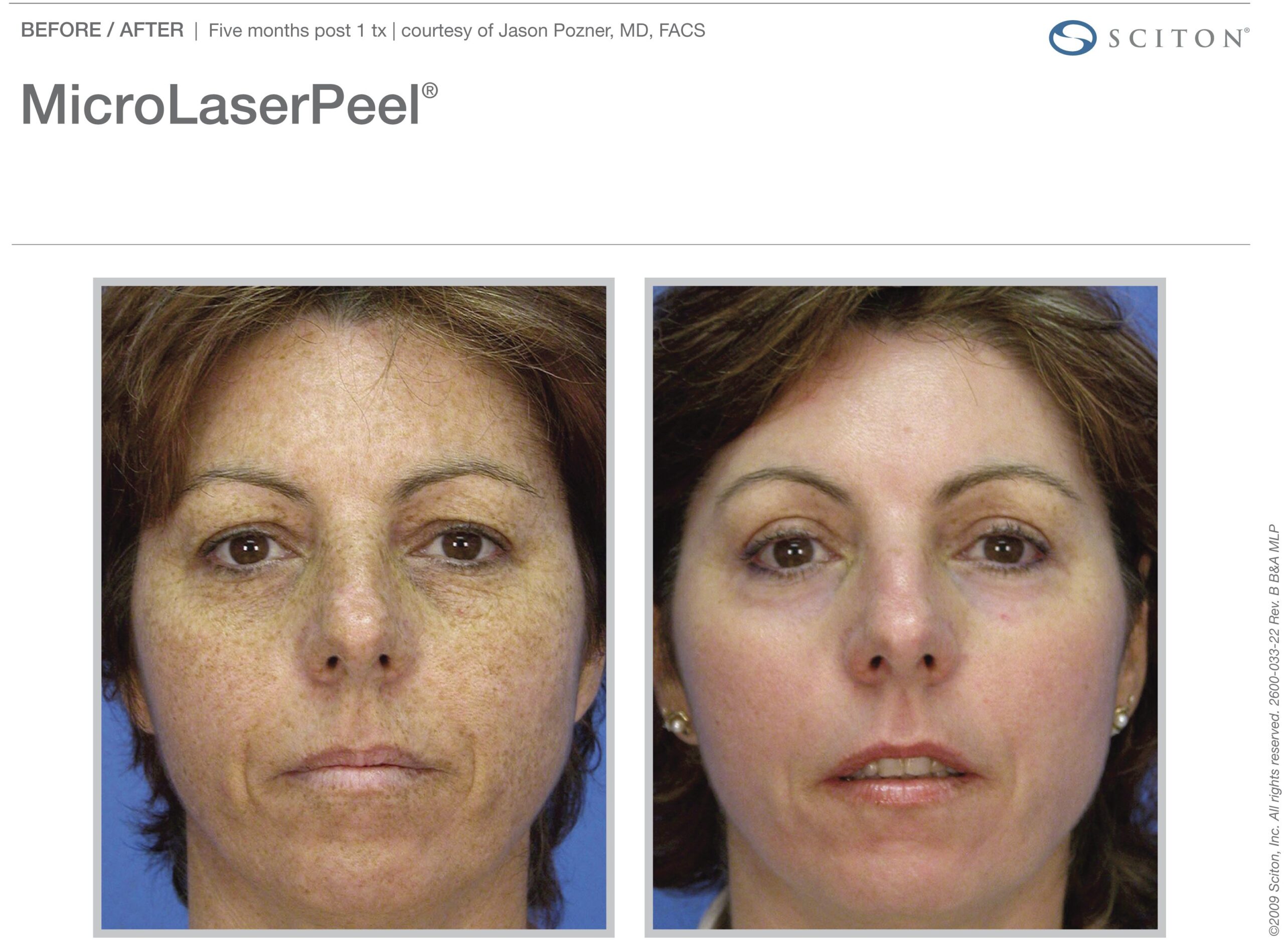 micro-laser-peel-before-after-9