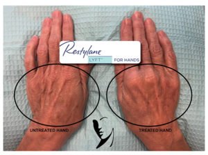 Restylane Hands before and after