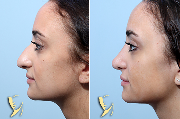Rhinoplasty Before After 130