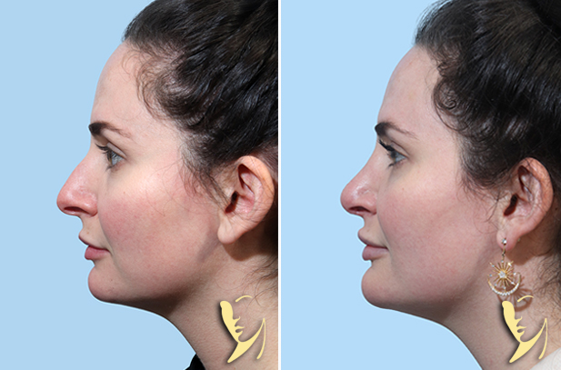 Rhinoplasty Before After 160