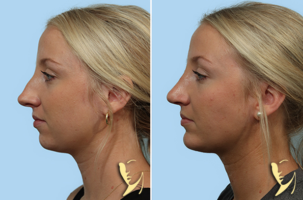 Rhinoplasty + Chin Implant Before and After 150