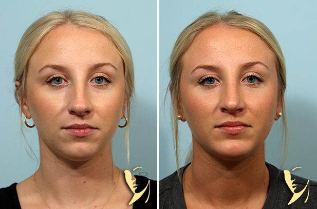 Rhinoplasty + Chin Implant Before and After Front View 150