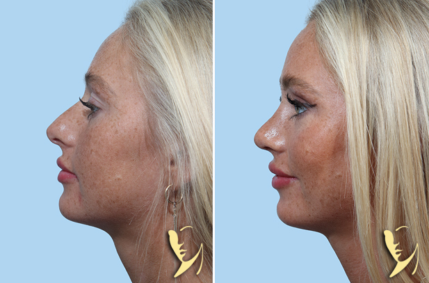 Rhinoplasty before after 155