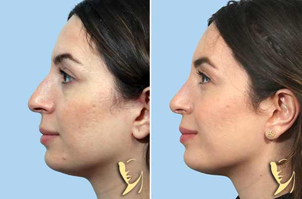 Rhinoplasty before after 175