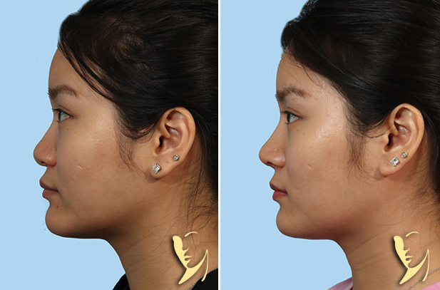 Rhinoplasty before after 180 side view