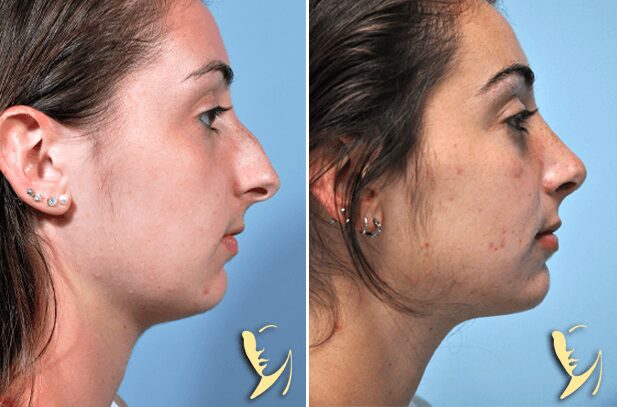 Rhinoplasty-before-after-50
