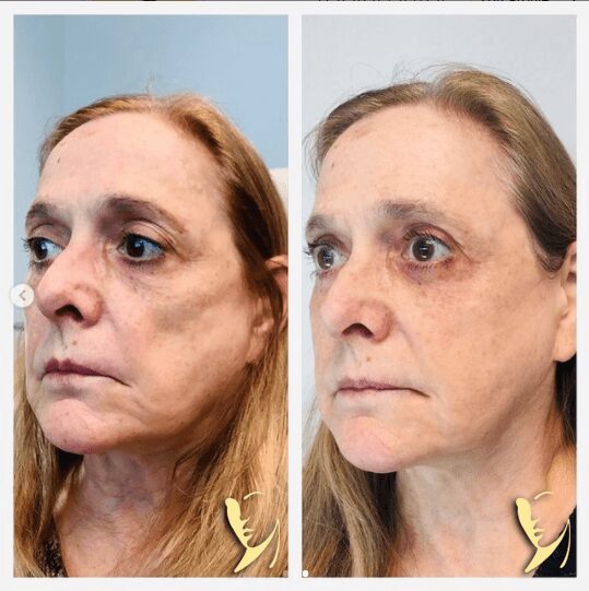 Side-by-side comparison of woman's facial changes.