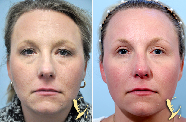 Upper and Lower Eyelids Blepharoplasty with submental lipectomy - platysmaplasty before after