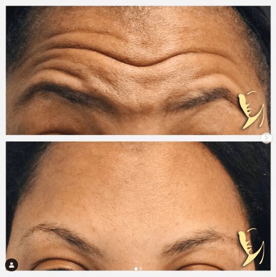 Wrinkle relaxing treatment
