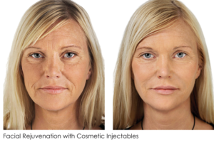 facial rejuvenation with cosmetic injectables