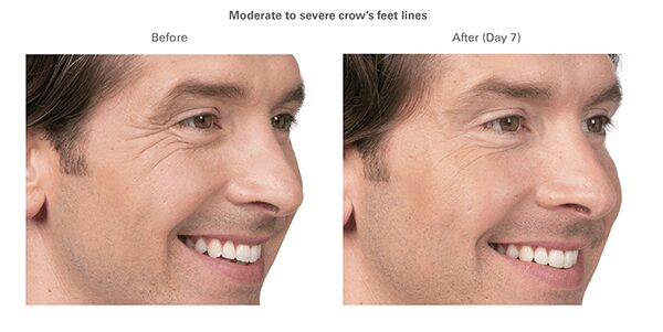 botox-before-after-Jim