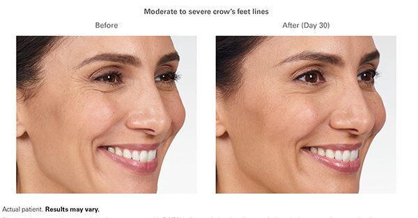 botox-before-after-alexandra