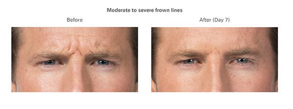 botox-before-after-andy1