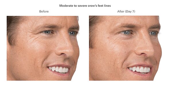 botox-before-after-andy2