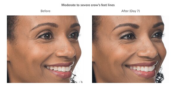 botox-before-after-ava