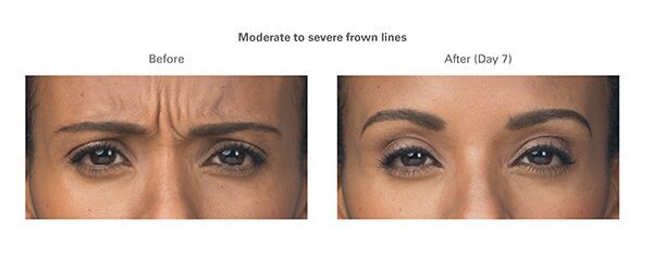 botox-before-after-ava1