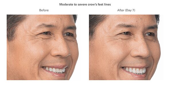 botox-before-after-clint1