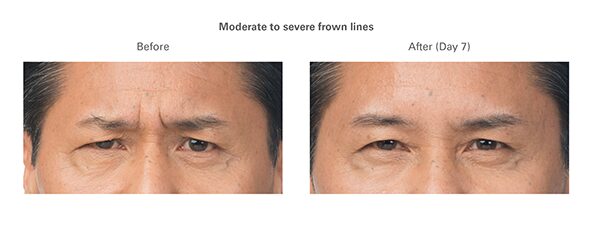 botox-before-after-clint2