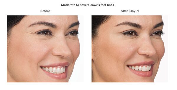 botox-before-after-cynthia