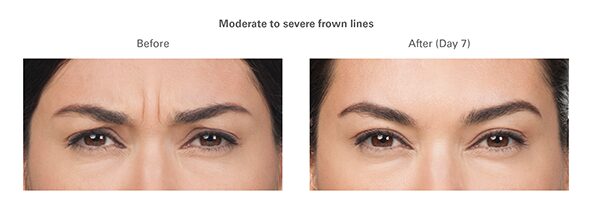 botox-before-after-cynthia1