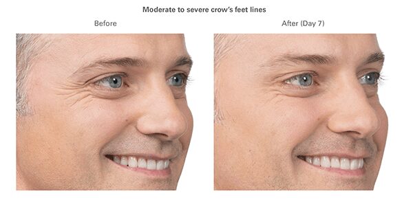 botox-before-after-max