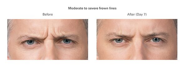 botox-before-after-max2